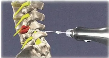 経皮的髄核摘出術