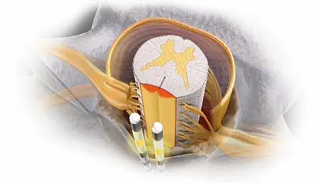 硬膜外脊髄刺激療法