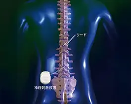 硬膜外脊髄刺激療法