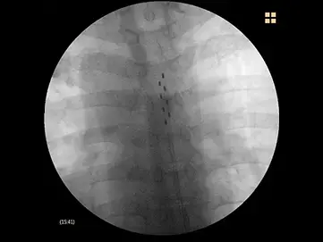 硬膜外脊髄刺激療法
