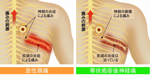 帯状疱疹後神経痛症状や原因 治療について 茨木市のペインクリニック ももたろう痛みのクリニック