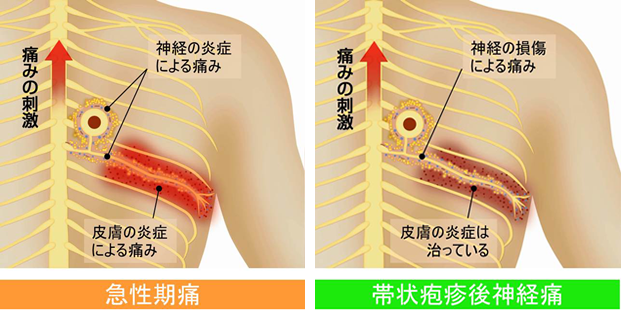 疱疹 後 神経痛 帯状 帯状疱疹後神経痛の症状,原因と治療の病院を探す